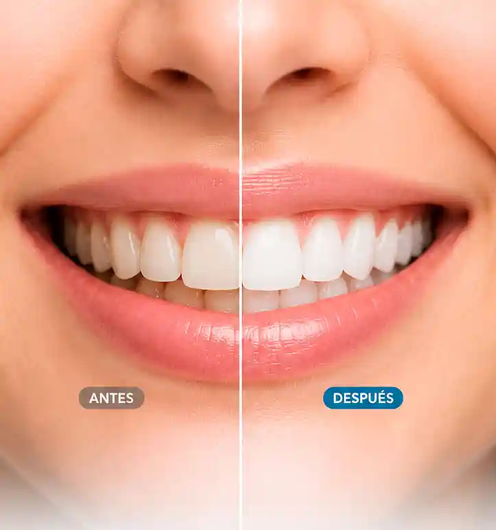 blanqueamiento dental Barcelona Clínica Sancho