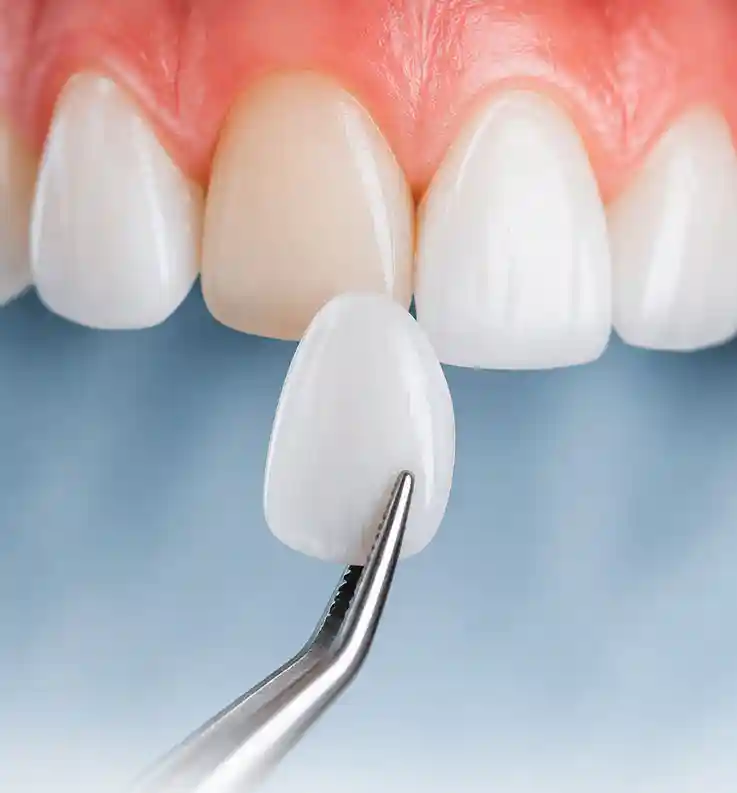 Qué son las carillas dentales — porcelana y composite