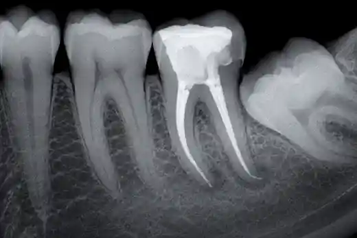 Endodoncia en Barcelona