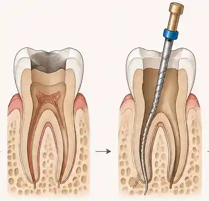 Qué es la endodoncia — pulpa y conductos del diente