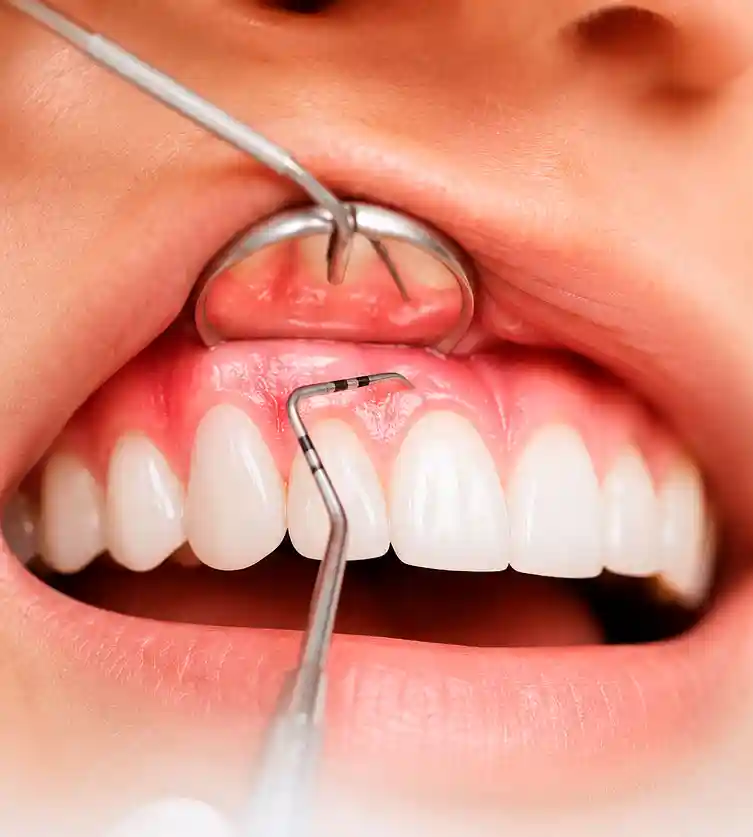 Periodoncia — salud de encías