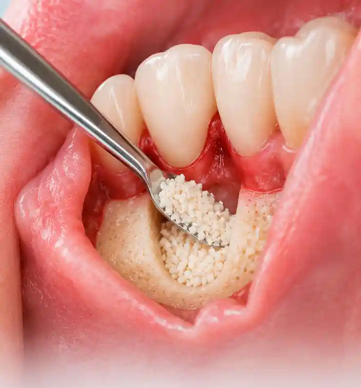 Empelt ossi dental — materials de regeneració